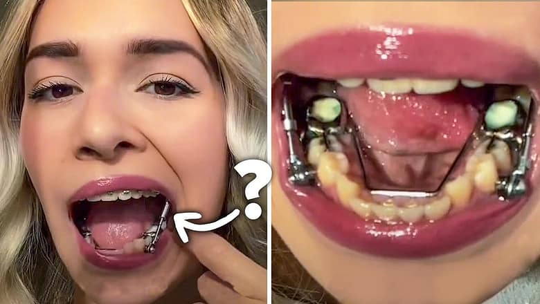 Eating With Metal Rods In My Mouth