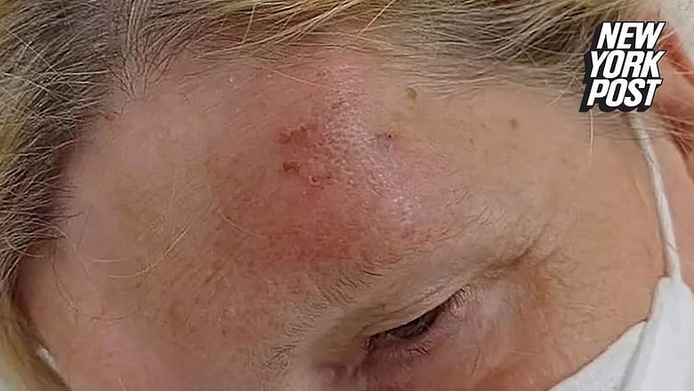 Tourist bitten by bat feared to have fatal virus: ‘I didn’t want to believe it’